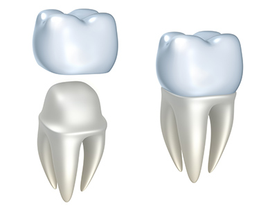Rendering of dental crown